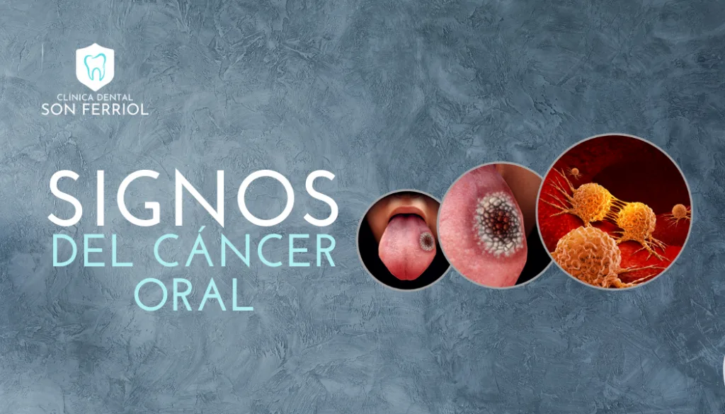signos del cancer oral