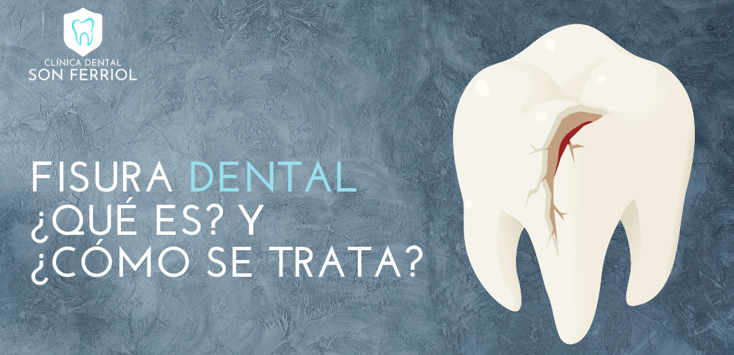Fisuras dentales. ¿Qué son? ¿Cómo tratarlas?