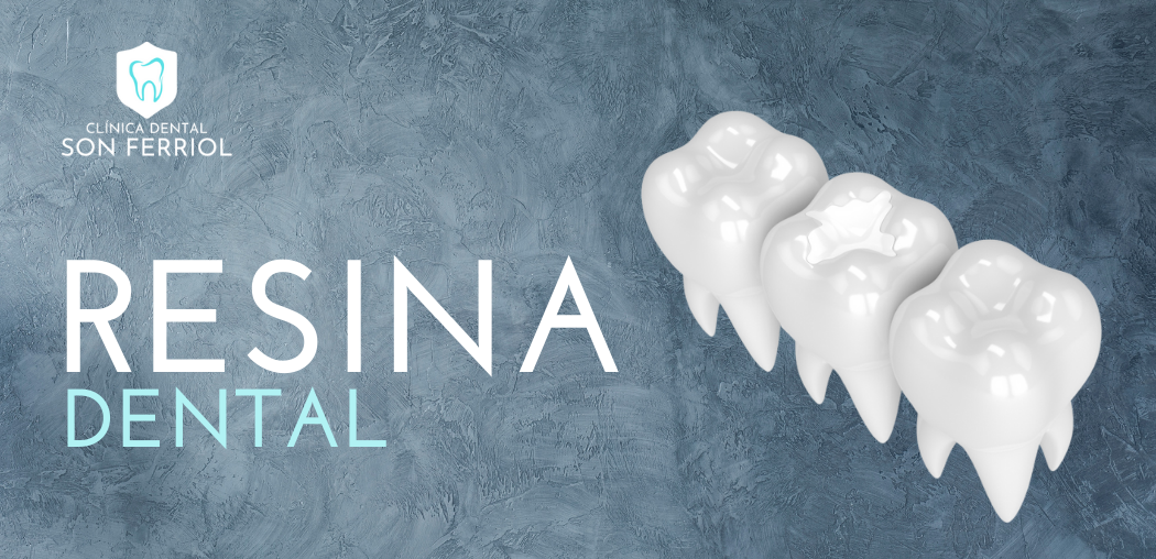 Todo lo que debes saber sobre la resina dental