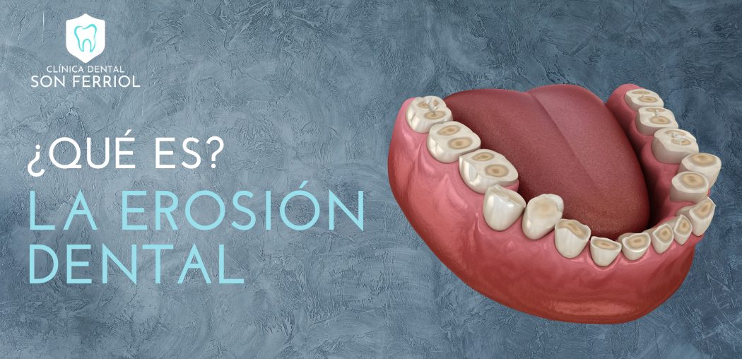 Qué es la erosión dental y cómo prevenirla