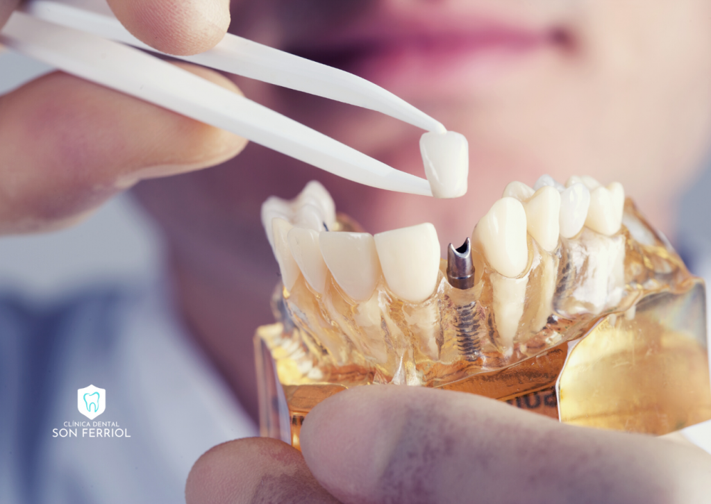 implante dental en son ferriol (1)