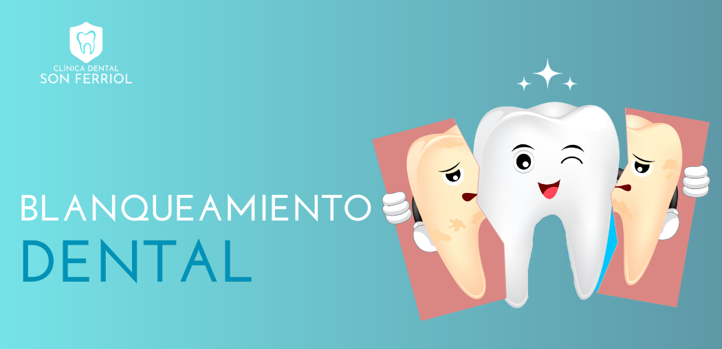 Blanqueamiento Dental: Mitos y Verdades Sobre Esta Popular Práctica
