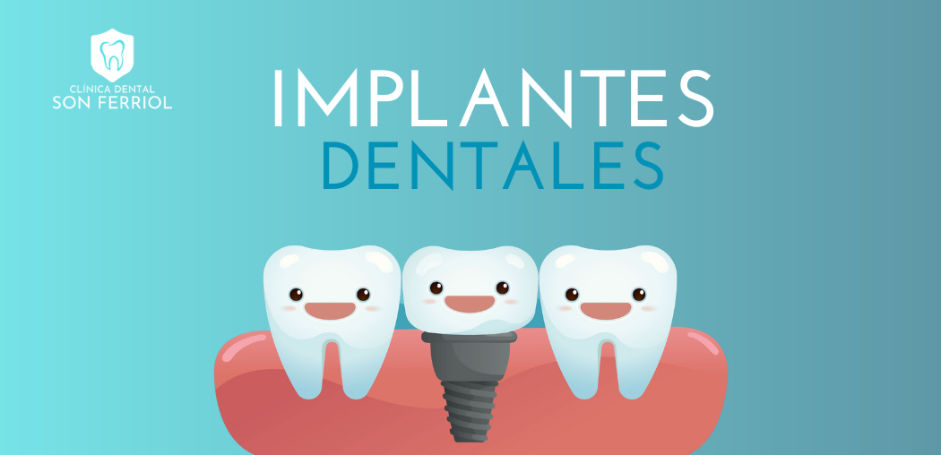 Implantes Dentales: Lo que Necesitas Saber antes de tu Próxima Consulta