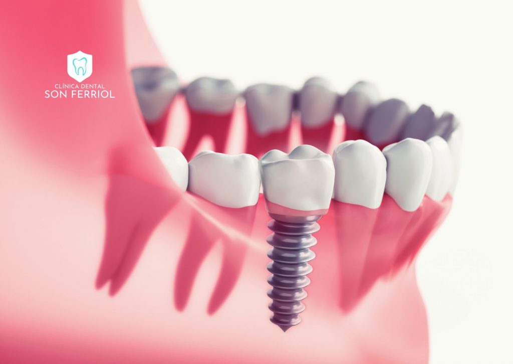 implantes dentales en mallorca