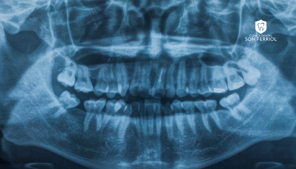 rayos X de dientes