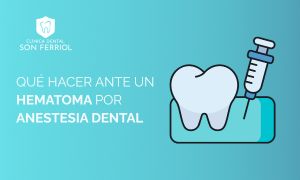 Qué hacer ante un hematoma por anestesia dental
